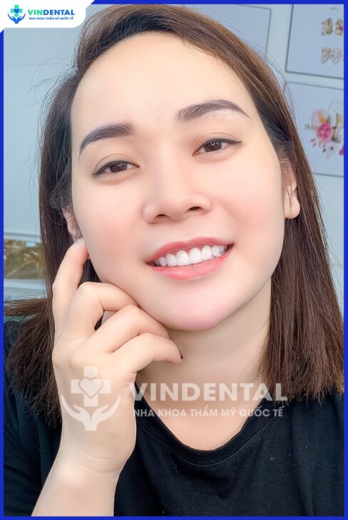 BỌC SỨ THẨM MỸ – LẮP RĂNG TRONG NGÀY