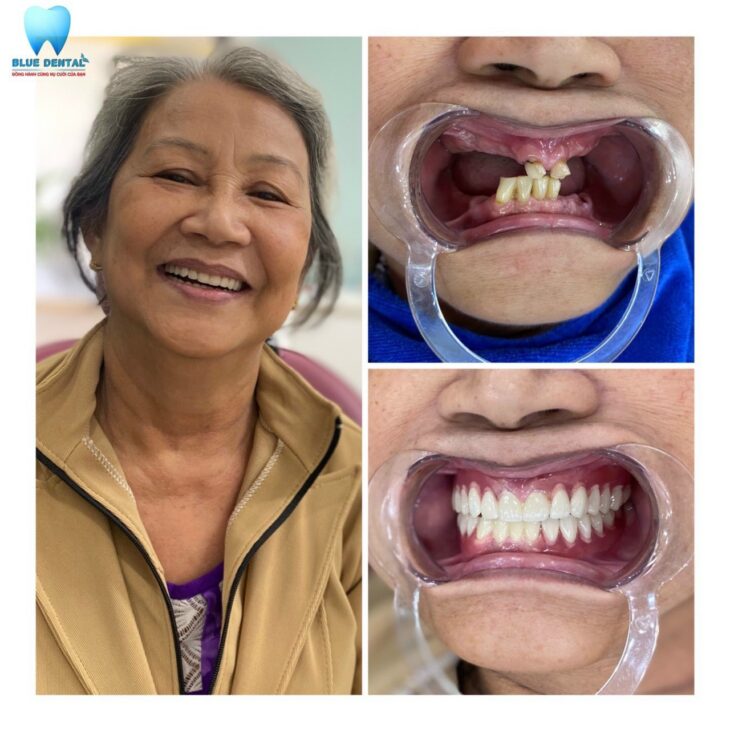 Địa chỉ làm răng uy tín tại quận Tân Bình? Nha khoa Blue dental – 169A Ba Vân, P.14, Q.Tân Bình, HCM