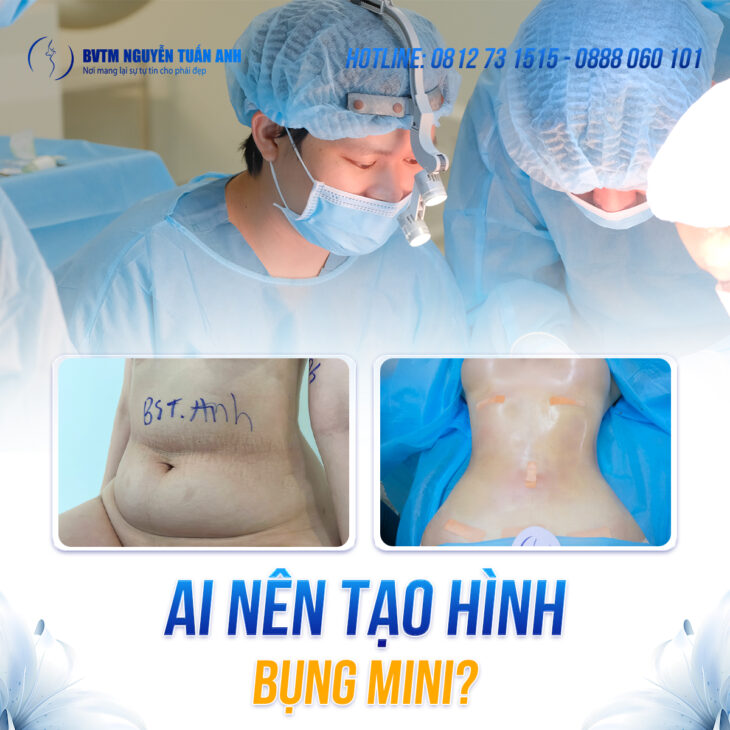 Tạo hình bụng mini