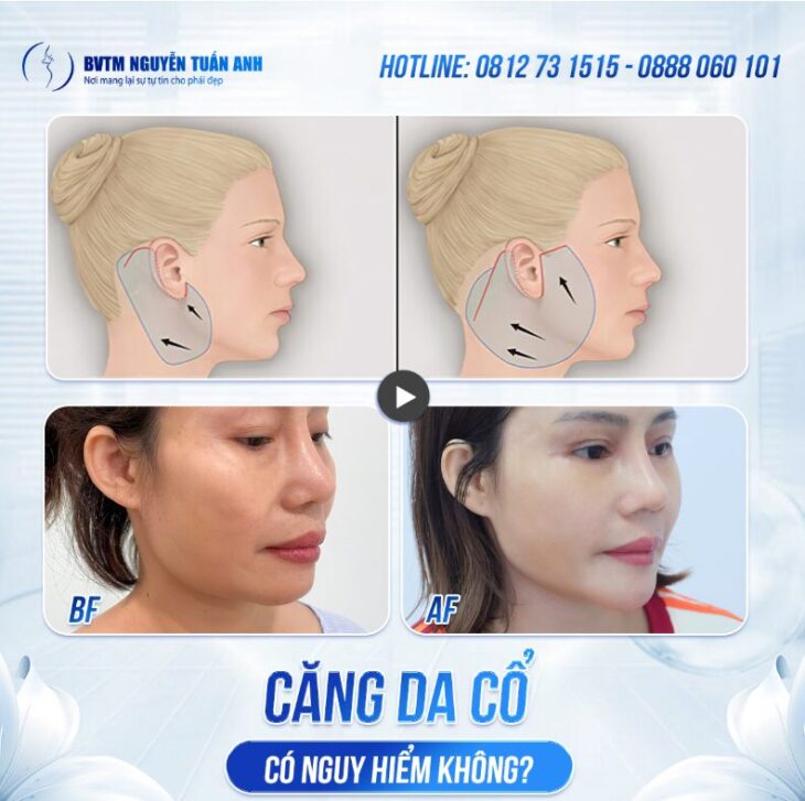 Căng da cổ và những điều cần thiết khi thực hiện