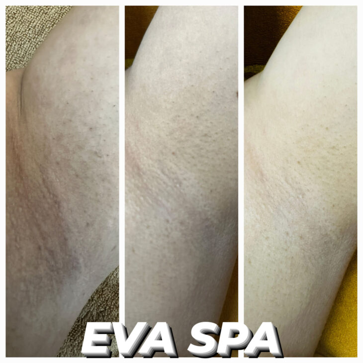 Ủ Bắn Trắng Nách tại Eva Spa Cần Thơ, trắng da, sáng mịn, hết thâm