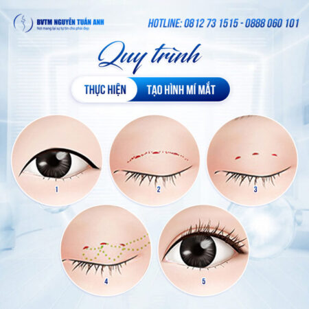 Tìm hiểu phương pháp sửa mí hiện nay