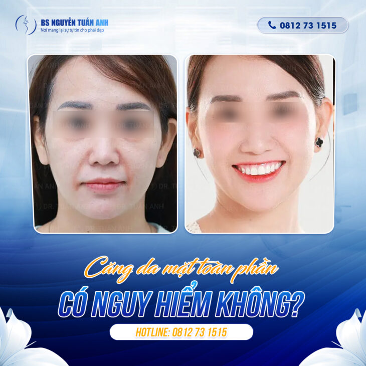 Căng da mặt toàn phần có nguy hiểm hay biến chứng gì không?
