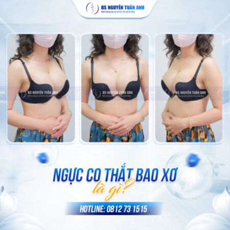 Xử lý co thắt bao xơ sau nâng ngực Những điều cần biết