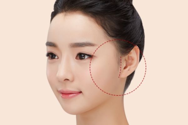 Căng da mặt mini có duy trì được lâu không