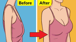 Ngực chảy xệ nhẹ có cần phẫu thuật treo sa trễ không