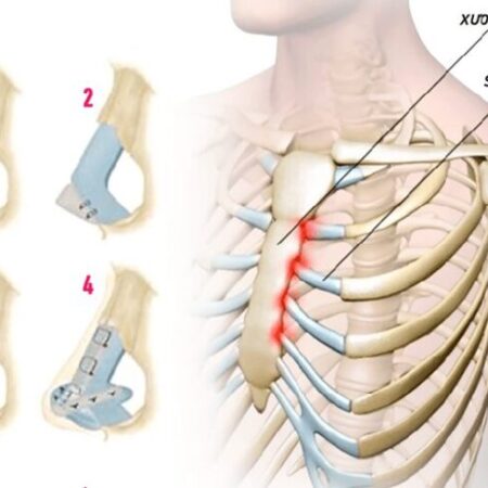 Có nên nâng mũi sụn sườn không? Góc nhìn từ yếu tố an toàn Có nên nâng mũi sụn sườn không? Góc nhìn từ yếu tố an toàn