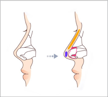 Mũi lộ sóng sau nâng mũi – Giải pháp an toàn và hiệu quả