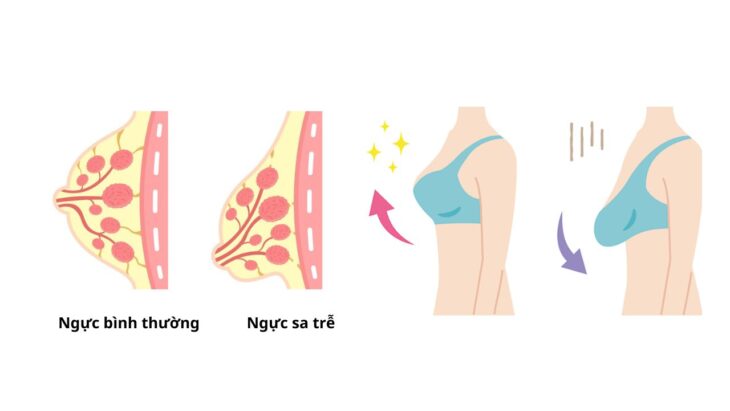 Treo sa trễ ngực mất bao lâu để ổn định hoàn toàn