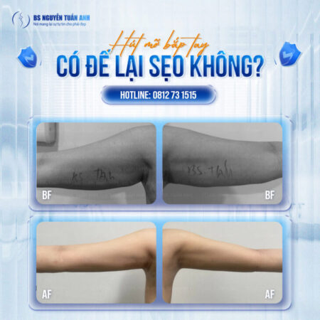 Hút mỡ tay có để lại sẹo không? Sẹo có dễ nhìn thấy không? Hút mỡ tay có để lại sẹo không? Sẹo có dễ nhìn thấy không?