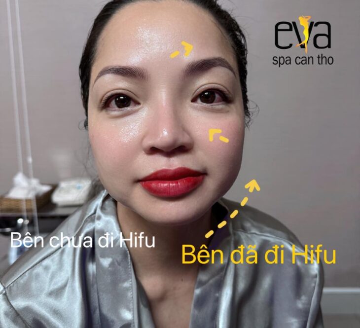 Ai Không Nên Làm HIFU? Danh Sách Chống Chỉ Định Bạn Cần Biết Trước Khi Đặt Lịch