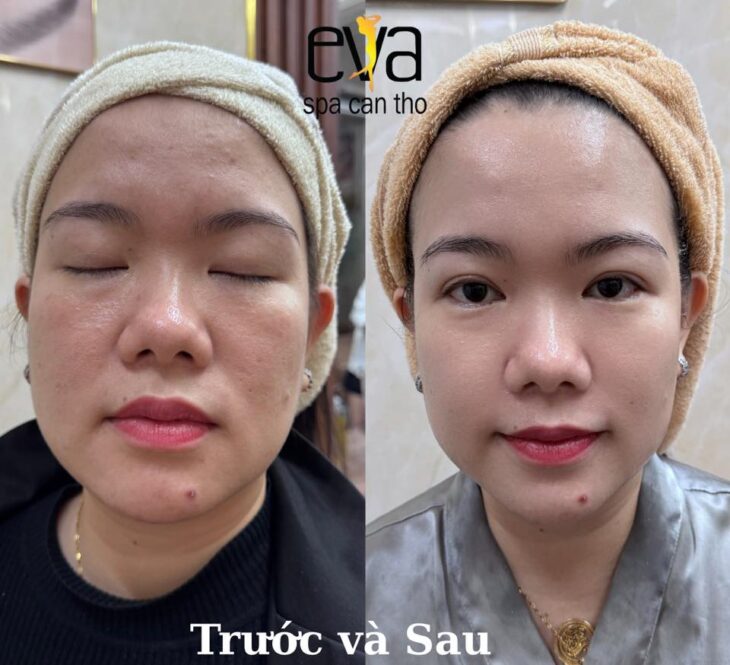 Ai Không Nên Làm HIFU? Danh Sách Chống Chỉ Định Bạn Cần Biết Trước Khi Đặt Lịch