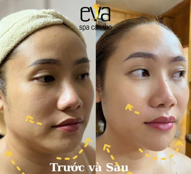 Ai Không Nên Làm HIFU? Danh Sách Chống Chỉ Định Bạn Cần Biết Trước Khi Đặt Lịch