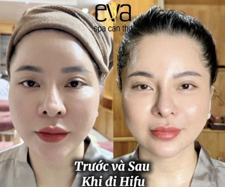 Ai Không Nên Làm HIFU? Danh Sách Chống Chỉ Định Bạn Cần Biết Trước Khi Đặt Lịch